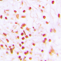 ERCC6 / CSB Antibody - Immunohistochemical analysis of ERCC6 staining in human lung cancer formalin fixed paraffin embedded tissue section. The section was pre-treated using heat mediated antigen retrieval with sodium citrate buffer (pH 6.0). The section was then incubated with the antibody at room temperature and detected using an HRP conjugated compact polymer system. DAB was used as the chromogen. The section was then counterstained with hematoxylin and mounted with DPX.