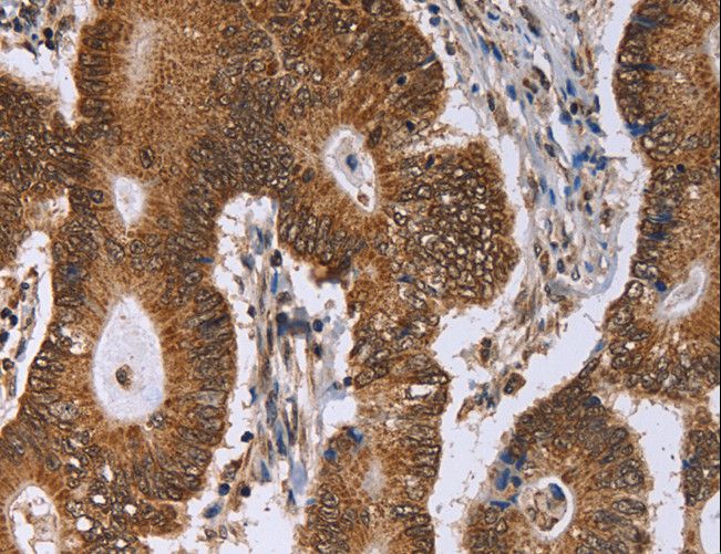 ERCC6L / FLJ20105 Antibody - Immunohistochemistry of paraffin-embedded Human colon cancer using ERCC6L Polyclonal Antibody at dilution of 1:30.