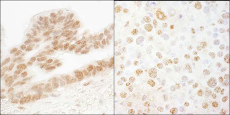 ERF / PE2 Antibody - Detection of Human and Mouse ERF by Immunohistochemistry. Sample: FFPE section of human ovarian carcinoma (left) and mouse renal cell carcinoma (right). Antibody: Affinity purified rabbit anti-ERF used at a dilution of 1:5000 (0.2 Detection: DAB.