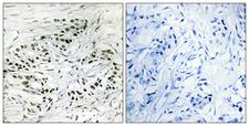 ERF / PE2 Antibody - Immunohistochemistry analysis of paraffin-embedded human breast carcinoma tissue, using ERF Antibody. The picture on the right is blocked with the synthesized peptide.
