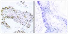 ERF / PE2 Antibody - Immunohistochemistry analysis of paraffin-embedded human colon carcinoma tissue, using ERF Antibody. The picture on the right is blocked with the synthesized peptide.