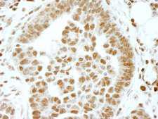 ERF / PE2 Antibody - Detection of Human ERF by Immunohistochemistry. Sample: FFPE section of human ovarian tumor. Antibody: Affinity purified rabbit anti-ERF used at a dilution of 1:100.
