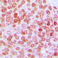 ERF / PE2 Antibody - Immunohistochemical analysis of PE2 staining in human ovarian cancer formalin fixed paraffin embedded tissue section. The section was pre-treated using heat mediated antigen retrieval with sodium citrate buffer (pH 6.0). The section was then incubated with the antibody at room temperature and detected using an HRP conjugated compact polymer system. DAB was used as the chromogen. The section was then counterstained with hematoxylin and mounted with DPX.