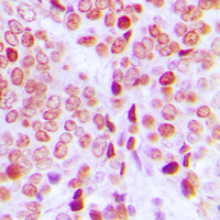 ERF / PE2 Antibody - Immunohistochemical analysis of PE2 (pT526) staining in human ovarian cancer formalin fixed paraffin embedded tissue section. The section was pre-treated using heat mediated antigen retrieval with sodium citrate buffer (pH 6.0). The section was then incubated with the antibody at room temperature and detected using an HRP conjugated compact polymer system. DAB was used as the chromogen. The section was then counterstained with hematoxylin and mounted with DPX.