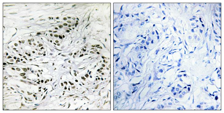 ERF / PE2 Antibody - Peptide - + Immunohistochemistry analysis of paraffin-embedded human breast carcinoma tissue, using ERF antibody.