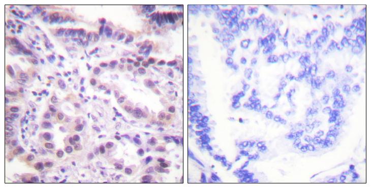 ERF / PE2 Antibody - P-peptide - + Immunohistochemistry analysis of paraffin-embedded human lung carcinoma tissue using ERF (Phospho-Thr526) antibody.