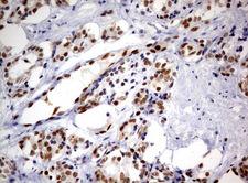 ERG Antibody - Immunohistochemical staining of paraffin-embedded Carcinoma of Human prostate tissue using anti-ERG mouse monoclonal antibody.  heat-induced epitope retrieval by 10mM citric buffer, pH6.0, 120C for 3min)