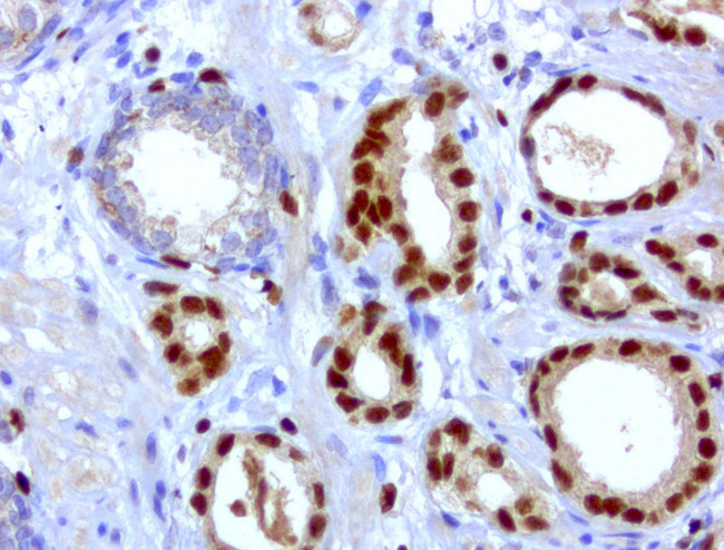 ERG Antibody - Immunohistochemical staining of paraffin-embedded human prostate cancer using anti-ERG clone UMAB77 at 1:200 dilution of 0.8mg/mL and detection with Polink2 Broad HRP DAB.requires heat-induced epitope retrieval with ACCEL. (pH8.7) biocare pressure cooker. The image shows prostate tumors staining in tumor cells.
