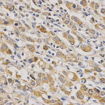 ERG Antibody - Immunohistochemistry of paraffin-embedded human stomach cancer tissue.