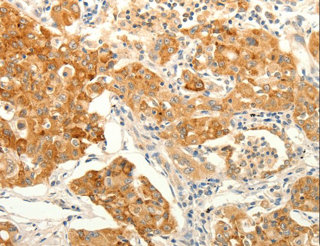 ERG Antibody - Immunohistochemistry of paraffin-embedded Human lung cancer using ERG Polyclonal Antibody at dilution of 1:30.