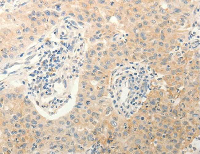 ERG Antibody - Immunohistochemistry of paraffin-embedded Human lung cancer using ERG Polyclonal Antibody at dilution of 1:40.