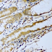ERG Antibody - Immunohistochemical analysis of ERG staining in human stomach cancer formalin fixed paraffin embedded tissue section. The section was pre-treated using heat mediated antigen retrieval with sodium citrate buffer (pH 6.0). The section was then incubated with the antibody at room temperature and detected using an HRP conjugated compact polymer system. DAB was used as the chromogen. The section was then counterstained with hematoxylin and mounted with DPX.