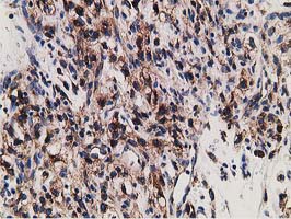 ERGIC-53 / LMAN1 Antibody - IHC of paraffin-embedded Carcinoma of Human kidney tissue using anti-LMAN1 mouse monoclonal antibody. (Heat-induced epitope retrieval by 10mM citric buffer, pH6.0, 100C for 10min).