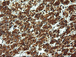 ERGIC-53 / LMAN1 Antibody - IHC of paraffin-embedded Carcinoma of Human liver tissue using anti-LMAN1 mouse monoclonal antibody. (Heat-induced epitope retrieval by 10mM citric buffer, pH6.0, 100C for 10min).