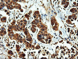 ERGIC-53 / LMAN1 Antibody - IHC of paraffin-embedded Carcinoma of Human lung tissue using anti-LMAN1 mouse monoclonal antibody. (Heat-induced epitope retrieval by 10mM citric buffer, pH6.0, 100C for 10min).