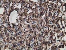 ERGIC-53 / LMAN1 Antibody - IHC of paraffin-embedded Carcinoma of Human kidney tissue using anti-LMAN1 mouse monoclonal antibody. (Heat-induced epitope retrieval by 10mM citric buffer, pH6.0, 100C for 10min).
