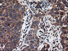 ERGIC-53 / LMAN1 Antibody - IHC of paraffin-embedded Carcinoma of Human bladder tissue using anti-LMAN1 mouse monoclonal antibody. (Heat-induced epitope retrieval by 10mM citric buffer, pH6.0, 100C for 10min).