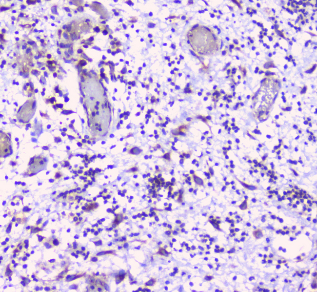 ERGIC-53 / LMAN1 Antibody - IHC analysis of LMAN1 using anti-LMAN1 antibody. LMAN1 was detected in paraffin-embedded section of human appendicitis tissue. Heat mediated antigen retrieval was performed in citrate buffer (pH6, epitope retrieval solution) for 20 mins. The tissue section was blocked with 10% goat serum. The tissue section was then incubated with 1µg/ml rabbit anti-LMAN1 Antibody overnight at 4°C. Biotinylated goat anti-rabbit IgG was used as secondary antibody and incubated for 30 minutes at 37°C. The tissue section was developed using Strepavidin-Biotin-Complex (SABC) with DAB as the chromogen.
