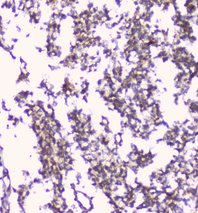 ERGIC-53 / LMAN1 Antibody - IHC analysis of LMAN1 using anti-LMAN1 antibody. LMAN1 was detected in paraffin-embedded section of human glioma tissue. Heat mediated antigen retrieval was performed in citrate buffer (pH6, epitope retrieval solution) for 20 mins. The tissue section was blocked with 10% goat serum. The tissue section was then incubated with 1µg/ml rabbit anti-LMAN1 Antibody overnight at 4°C. Biotinylated goat anti-rabbit IgG was used as secondary antibody and incubated for 30 minutes at 37°C. The tissue section was developed using Strepavidin-Biotin-Complex (SABC) with DAB as the chromogen.