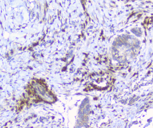 ERGIC-53 / LMAN1 Antibody - IHC analysis of LMAN1 using anti-LMAN1 antibody. LMAN1 was detected in paraffin-embedded section of human oesophagus squama cancer tissue. Heat mediated antigen retrieval was performed in citrate buffer (pH6, epitope retrieval solution) for 20 mins. The tissue section was blocked with 10% goat serum. The tissue section was then incubated with 1µg/ml rabbit anti-LMAN1 Antibody overnight at 4°C. Biotinylated goat anti-rabbit IgG was used as secondary antibody and incubated for 30 minutes at 37°C. The tissue section was developed using Strepavidin-Biotin-Complex (SABC) with DAB as the chromogen.