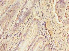 ERGIC1 Antibody - Immunohistochemistry of paraffin-embedded human colon cancer using antibody at 1:100 dilution.  This image was taken for the unconjugated form of this product. Other forms have not been tested.