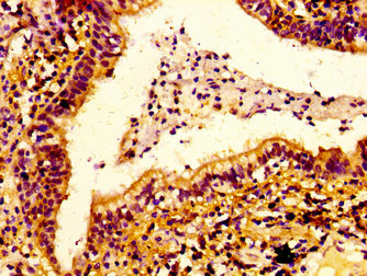 ERGIC2 Antibody - Immunohistochemistry image at a dilution of 1:100 and staining in paraffin-embedded human lung cancer performed on a Leica BondTM system. After dewaxing and hydration, antigen retrieval was mediated by high pressure in a citrate buffer (pH 6.0) . Section was blocked with 10% normal goat serum 30min at RT. Then primary antibody (1% BSA) was incubated at 4 °C overnight. The primary is detected by a biotinylated secondary antibody and visualized using an HRP conjugated SP system.