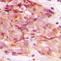 ERGIC3 Antibody - Immunohistochemical analysis of ERGIC3 staining in human breast cancer formalin fixed paraffin embedded tissue section. The section was pre-treated using heat mediated antigen retrieval with sodium citrate buffer (pH 6.0). The section was then incubated with the antibody at room temperature and detected with HRP and DAB as chromogen. The section was then counterstained with hematoxylin and mounted with DPX.