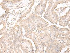 ERGIC3 Antibody - Immunohistochemistry of paraffin-embedded Human thyroid cancer tissue  using ERGIC3 Polyclonal Antibody at dilution of 1:50(×200)