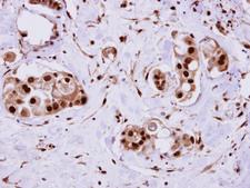 ERH Antibody - ERH antibody detects ERH protein at cytosol on Breast Carcinoma by immunohistochemical analysis. Sample: Paraffin-embedded Breast Carcinoma. ERH antibody dilution:1:500.