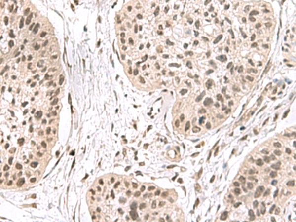 ERH Antibody - Immunohistochemistry of paraffin-embedded Human esophagus cancer tissue  using ERH Polyclonal Antibody at dilution of 1:55(×200)
