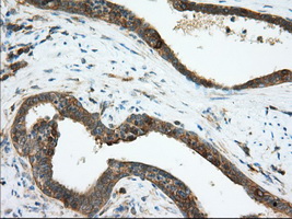 ERIC-1 / TACC3 Antibody - IHC of paraffin-embedded Carcinoma of Human prostate tissue using anti-TACC3 mouse monoclonal antibody. (Dilution 1:50).