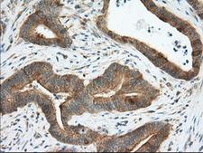 ERIC-1 / TACC3 Antibody - IHC of paraffin-embedded Adenocarcinoma of Human colon tissue using anti-TACC3 mouse monoclonal antibody. (Dilution 1:50).