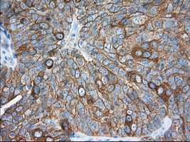 ERIC-1 / TACC3 Antibody - IHC of paraffin-embedded Adenocarcinoma of Human ovary tissue using anti-TACC3 mouse monoclonal antibody. (Dilution 1:50).