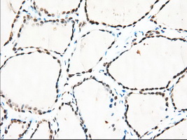 ERIC-1 / TACC3 Antibody - Immunohistochemical staining of paraffin-embedded Human thyroid tissue using anti-TACC3 mouse monoclonal antibody. (Dilution 1:50).