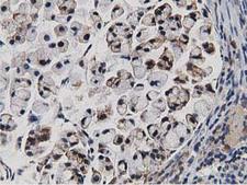ERIC-1 / TACC3 Antibody - IHC of paraffin-embedded Adenocarcinoma of Human colon tissue using anti-TACC3 mouse monoclonal antibody.
