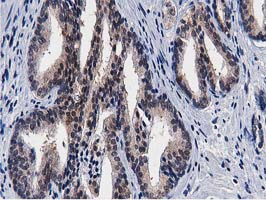 ERIC-1 / TACC3 Antibody - IHC of paraffin-embedded Carcinoma of Human prostate tissue using anti-TACC3 mouse monoclonal antibody.