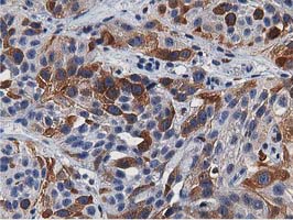 ERIC-1 / TACC3 Antibody - IHC of paraffin-embedded Carcinoma of Human bladder tissue using anti-TACC3 mouse monoclonal antibody.