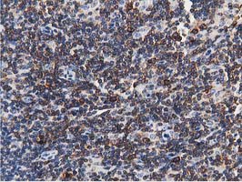 ERIC-1 / TACC3 Antibody - IHC of paraffin-embedded Human lymphoma tissue using anti-TACC3 mouse monoclonal antibody.