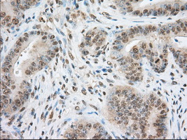 ERIC-1 / TACC3 Antibody - IHC of paraffin-embedded Adenocarcinoma of colon tissue using anti-TACC3 mouse monoclonal antibody. (Dilution 1:50).