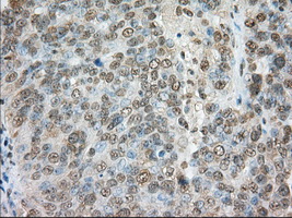 ERIC-1 / TACC3 Antibody - IHC of paraffin-embedded Adenocarcinoma of ovary tissue N93ing anti-TACC3 mouse monoclonal antibody. (Dilution 1:50).