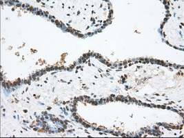 ERIC-1 / TACC3 Antibody - IHC of paraffin-embedded Carcinoma of prostate tissue using anti-TACC3 mouse monoclonal antibody. (Dilution 1:50).