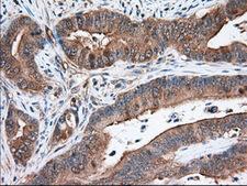 ERIC-1 / TACC3 Antibody - Immunohistochemical staining of paraffin-embedded Adenocarcinoma of Human colon tissue using anti-TACC3 mouse monoclonal antibody. (Dilution 1:50).