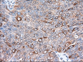 ERIC-1 / TACC3 Antibody - Immunohistochemical staining of paraffin-embedded Adenocarcinoma of Human ovary tissue using anti-TACC3 mouse monoclonal antibody. (Dilution 1:50).