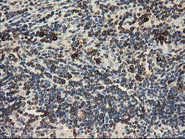 ERIC-1 / TACC3 Antibody - IHC of paraffin-embedded Human lymphoma tissue using anti-TACC3 mouse monoclonal antibody. (Heat-induced epitope retrieval by 10mM citric buffer, pH6.0, 100C for 10min).