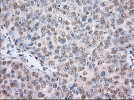 ERIC-1 / TACC3 Antibody - IHC of paraffin-embedded Adenocarcinoma of Human ovary tissue using anti-TACC3 mouse monoclonal antibody. (Dilution 1:50).