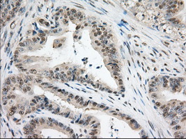 ERIC-1 / TACC3 Antibody - IHC of paraffin-embedded Adenocarcinoma of Human colon tissue using anti-TACC3 mouse monoclonal antibody. (Dilution 1:50).