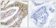 ERIC-1 / TACC3 Antibody - Peptide - + Immunohistochemistry analysis of paraffin-embedded human lung carcinoma tissue using TACC3 antibody.
