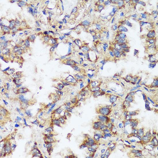 ERK1 + ERK2 Antibody - Immunohistochemistry of paraffin-embedded Human lung cancer using ERK1 / ERK2 Polyclonal Antibody at dilution of 1:200 (40x lens).