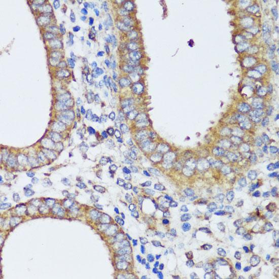 ERK1 + ERK2 Antibody - Immunohistochemistry of paraffin-embedded Human uterine cancer using ERK1 / ERK2 Polyclonal Antibody at dilution of 1:200 (40x lens).