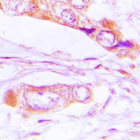 ERK1 + ERK2 Antibody - Immunohistochemical analysis of ERK1/2 (pT202/Y204) staining in human lung cancer formalin fixed paraffin embedded tissue section. The section was pre-treated using heat mediated antigen retrieval with sodium citrate buffer (pH 6.0). The section was then incubated with the antibody at room temperature and detected using an HRP conjugated compact polymer system. DAB was used as the chromogen. The section was then counterstained with hematoxylin and mounted with DPX.